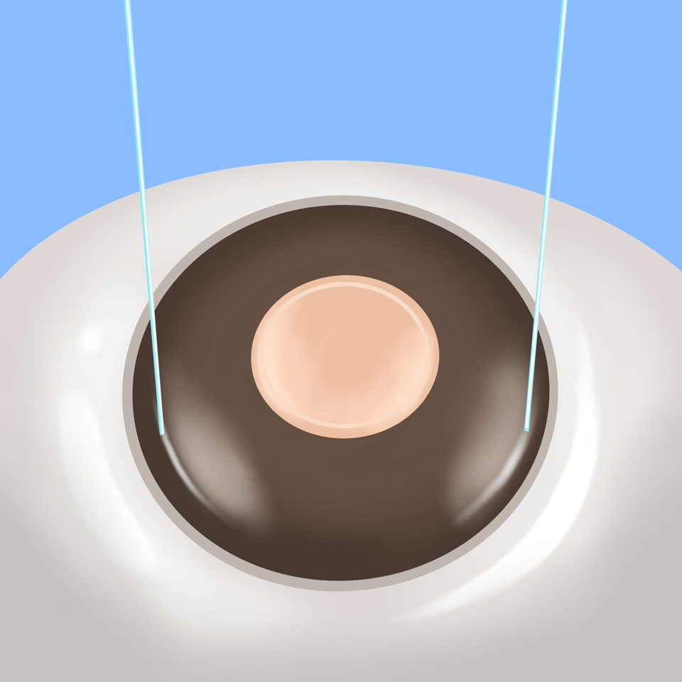 cataract_feature