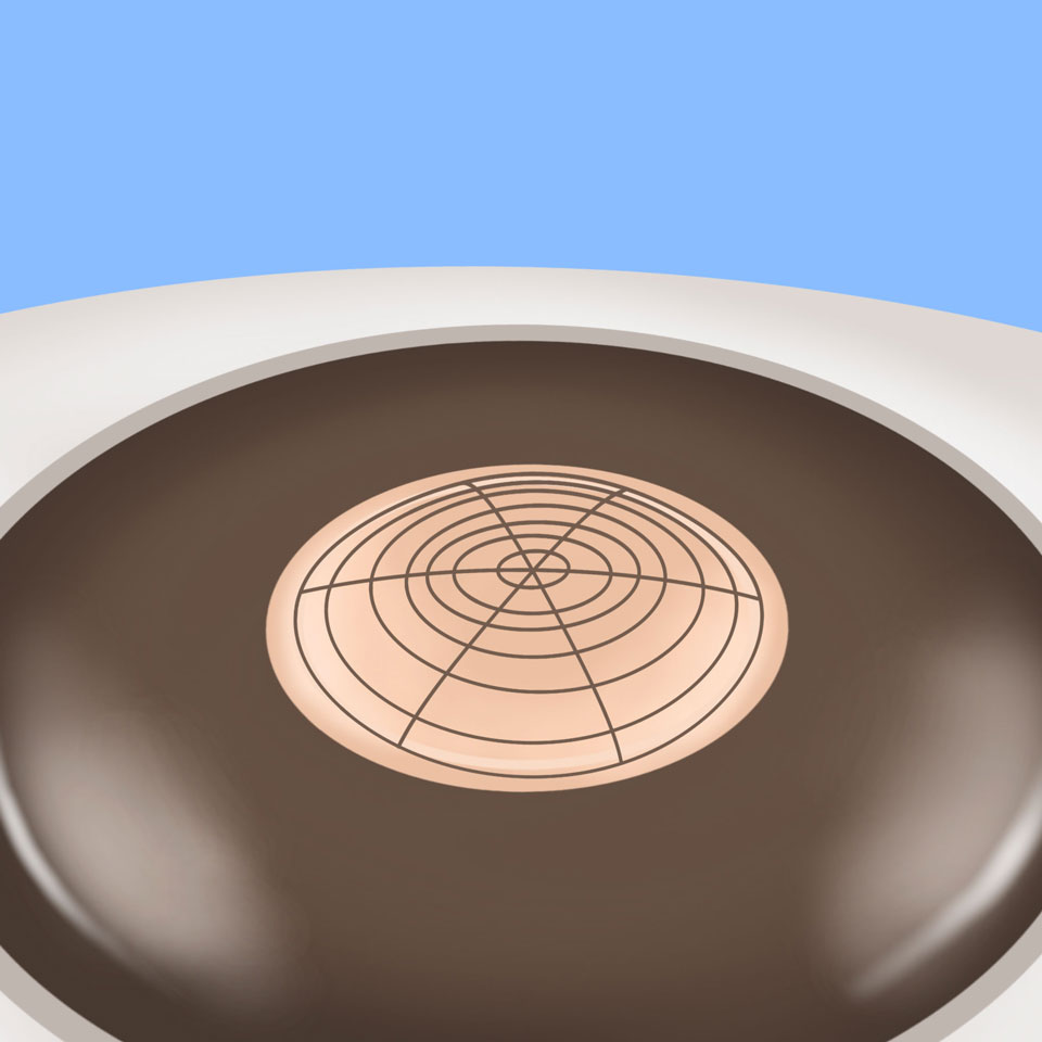 cataract_feature