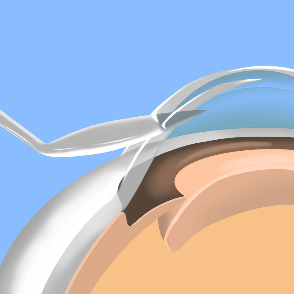 cataract_feature