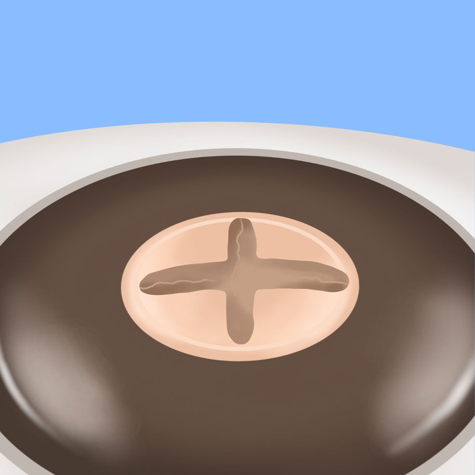 cataract_feature