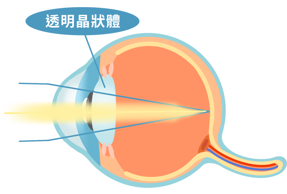 cataract_test