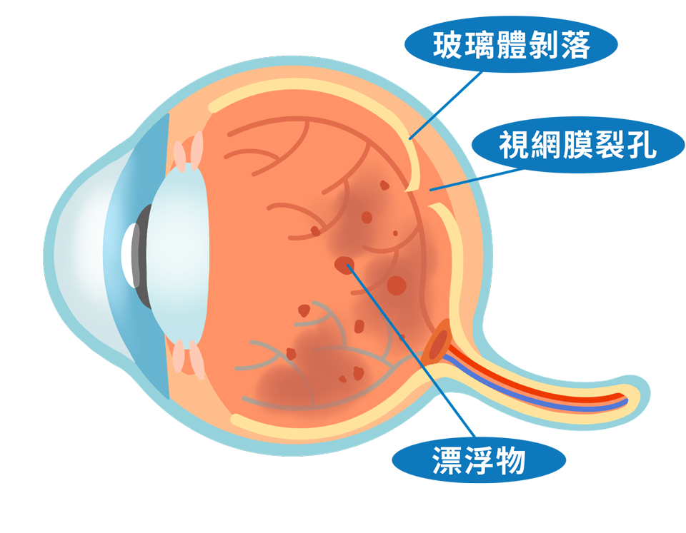ecd_floaters_type