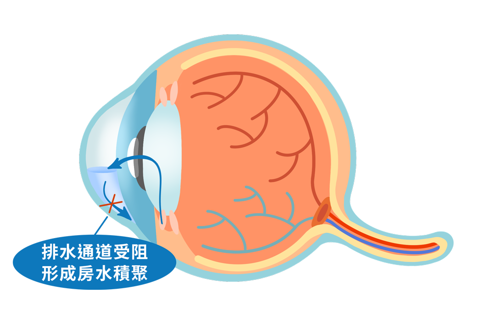 ecd_glaucoma_know