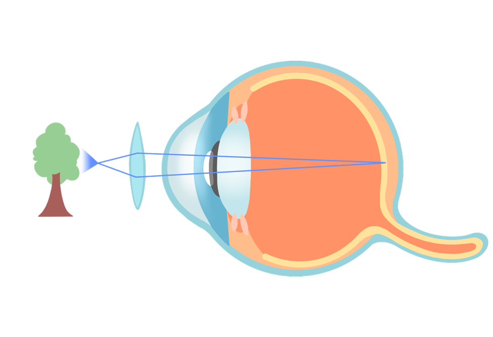 ecd_presbyopia_type