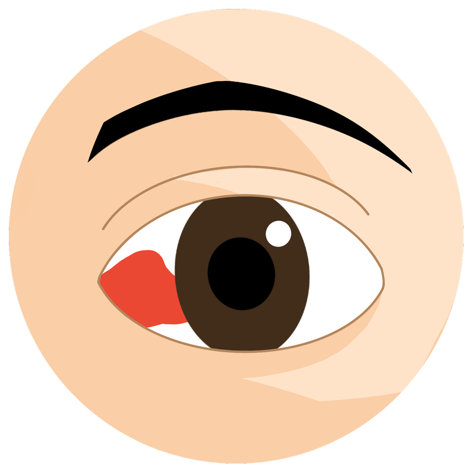 ecd_subconjunctival_hemorrhage_type